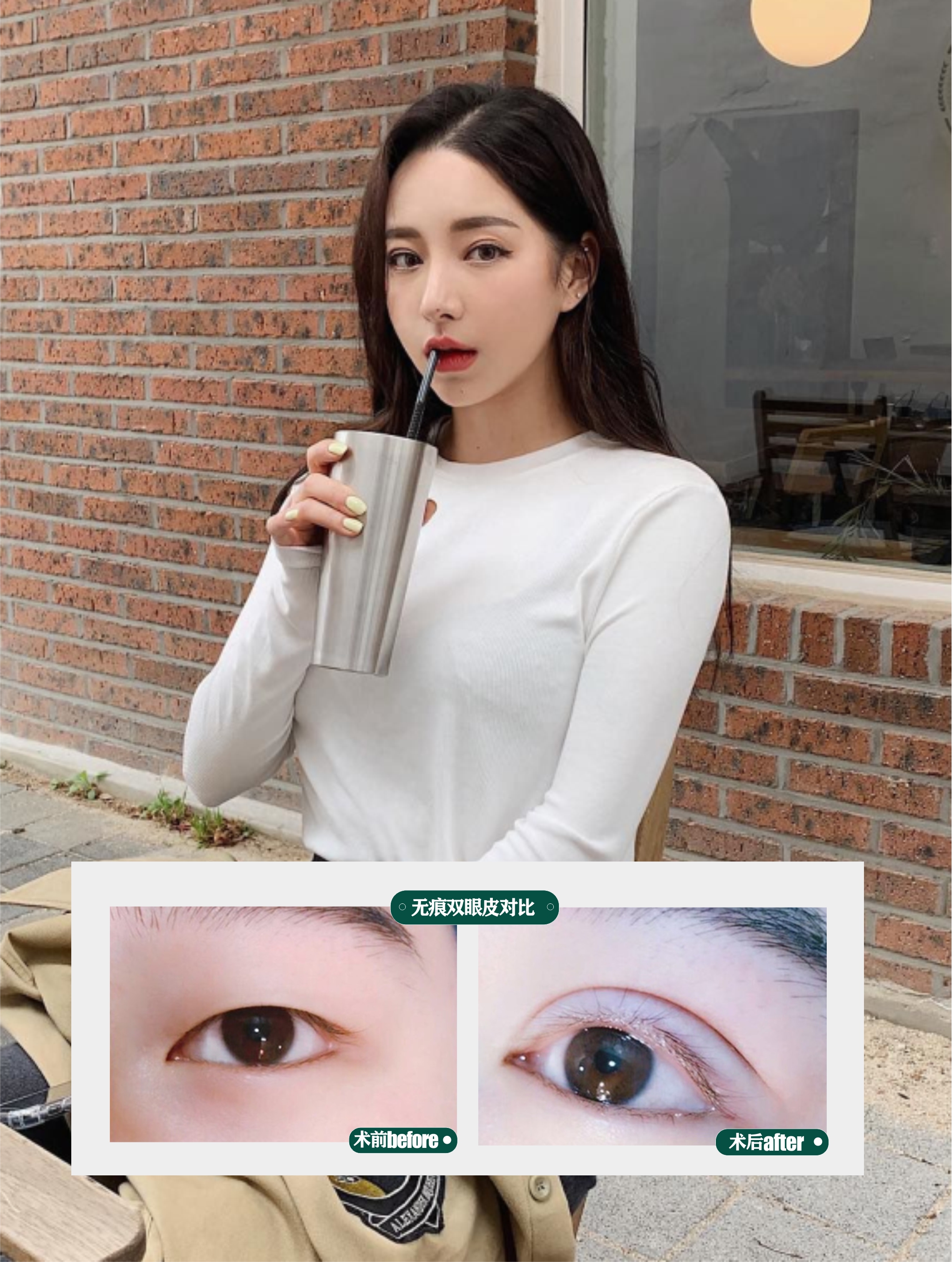 👁️ Cắt mí mắt